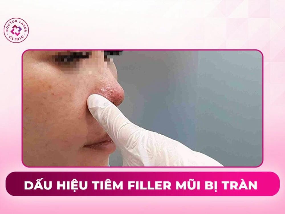 Kỹ thuật và yếu tố làm giảm nguy cơ tràn khi nâng mũi bằng filler