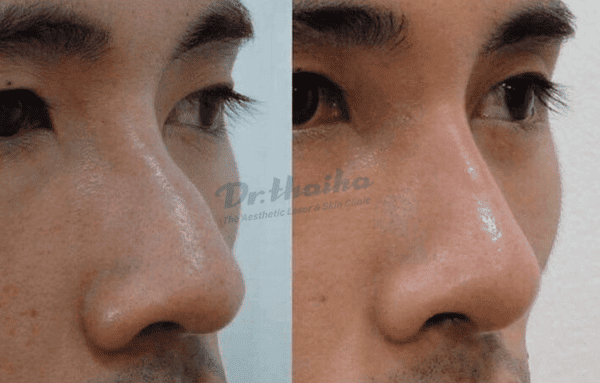 Tiêm filler mũi bằng kim hay cannula đầu tù — phương pháp nào an toàn hơn?