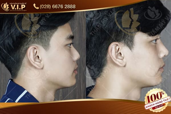 Quy trình chuẩn trước — trong — sau khi tiêm filler mũi cho nam (bước theo bước)