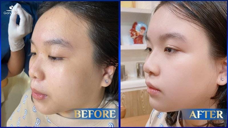 Tiêm filler mũi chơi bao lâu thì thấy kết quả — và kết quả đó duy trì được bao lâu?