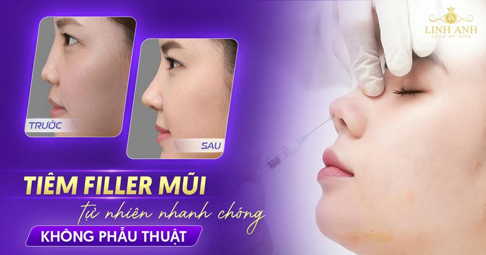 Các loại filler phù hợp cho mũi và đề xuất lựa chọn tại Việt Nam