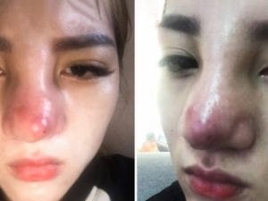 Ai không phù hợp để tiêm filler mũi?
