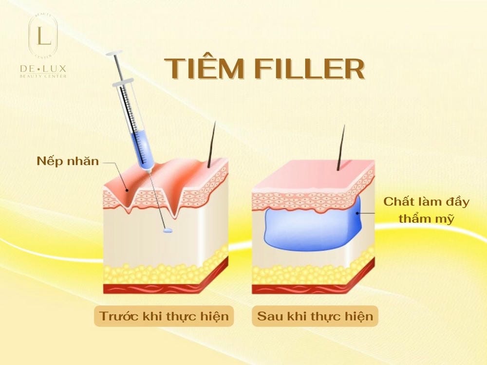 Quy trình an toàn khi tiêm filler mũi — cần có những bước gì?