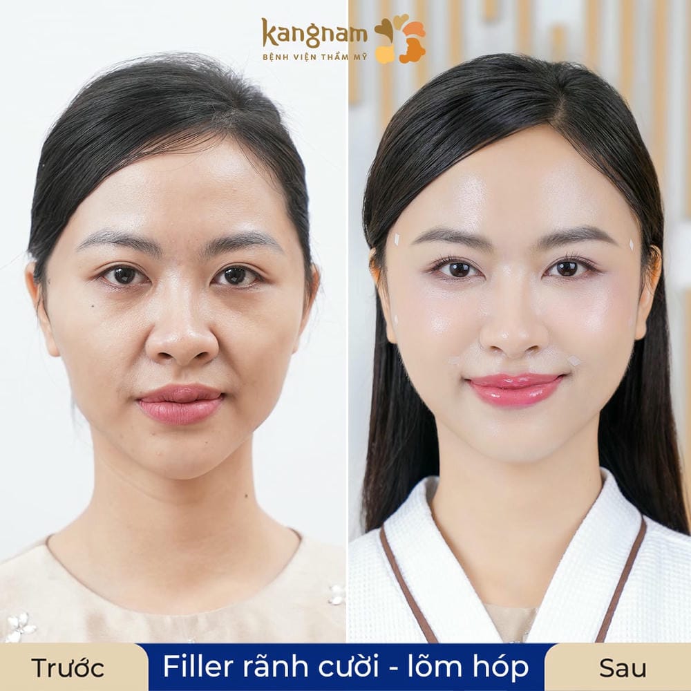 Ai không nên tiêm filler mũi — chống chỉ định và lưu ý đặc biệt?