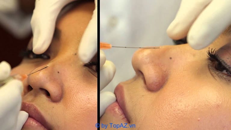 Quy trình tiêm filler mũi thường diễn ra như thế nào và bạn sẽ cảm thấy gì ở mỗi bước?
