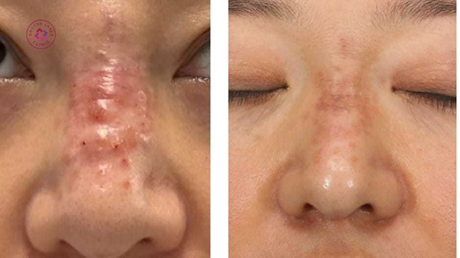Bằng chứng lâm sàng tóm tắt về đau và an toàn khi tiêm filler mũi