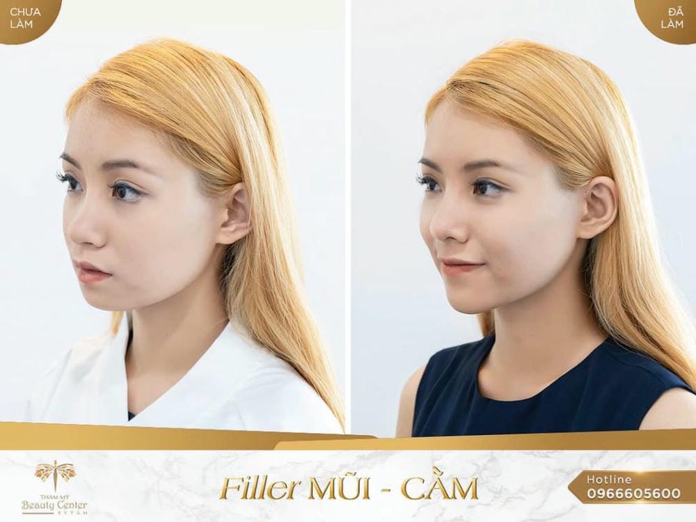 Tiêm filler mũi an toàn — nhận diện biến chứng tắc mạch cần biết