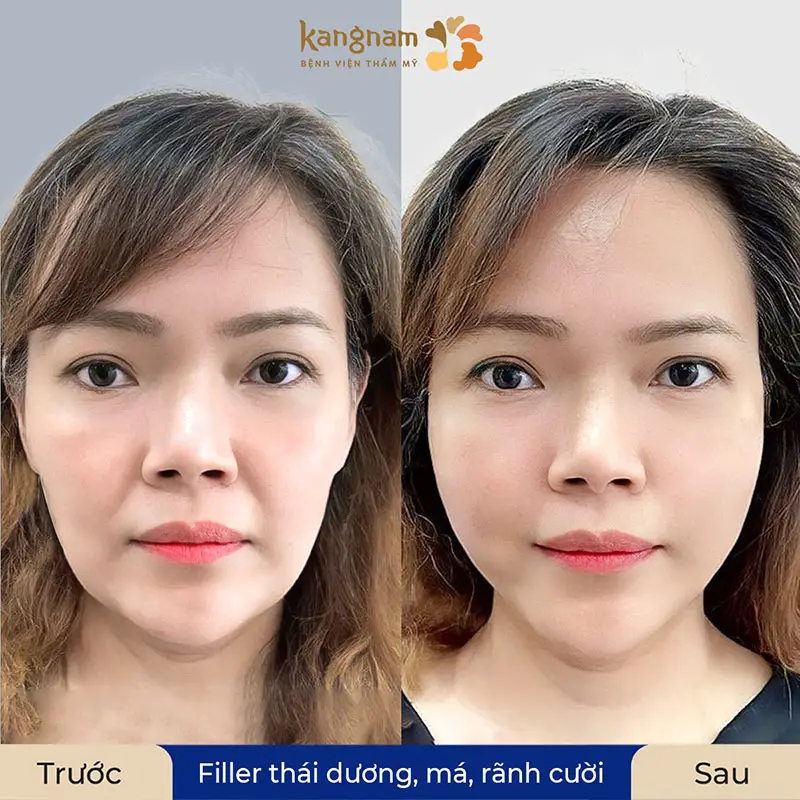Tiêm filler mũi cần bao nhiêu cc trong các trường hợp thường gặp?