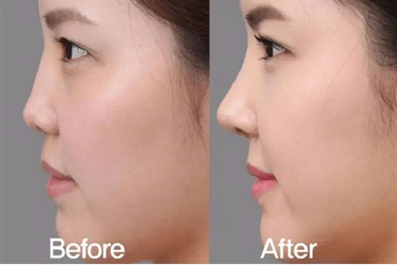 Những dấu hiệu cảnh báo biến chứng (tắc mạch, nhiễm trùng) — phải xử trí như thế nào?