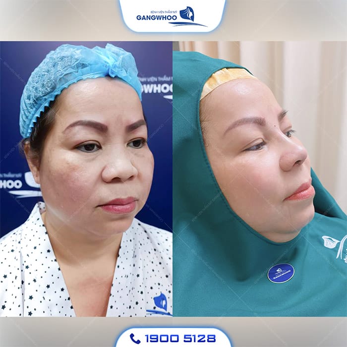 Tiêm filler mũi (nâng mũi không phẫu thuật) hay phẫu thuật nâng mũi — nên chọn phương pháp nào?