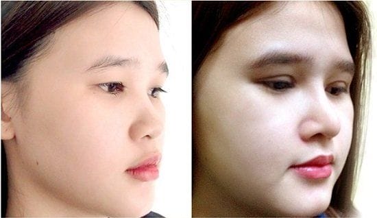 Ai phù hợp và ai không nên tiêm filler mũi hếch?