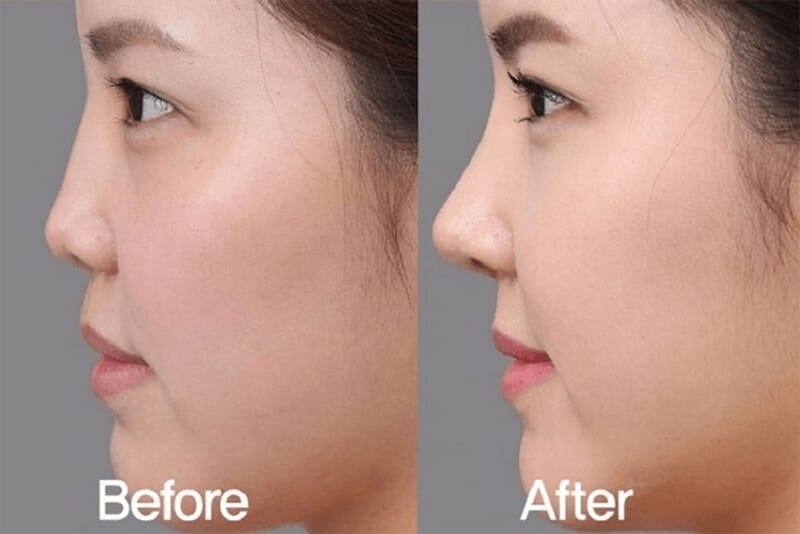 Loại filler nào nên ưu tiên khi muốn nâng mũi — vĩnh viễn hay có thể đảo ngược?