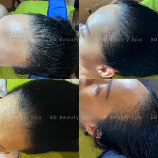 Tiêm filler mọc tóc thực chất là gì và cơ chế tác động ra sao?