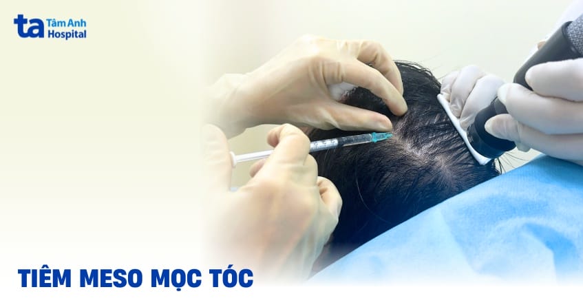 Nếu tôi nghĩ về tiêm filler mọc tóc — ai phù hợp và ai không phù hợp?