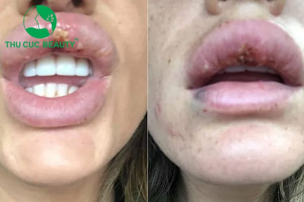 Cơ chế gây nốt viêm muộn và biofilm filler