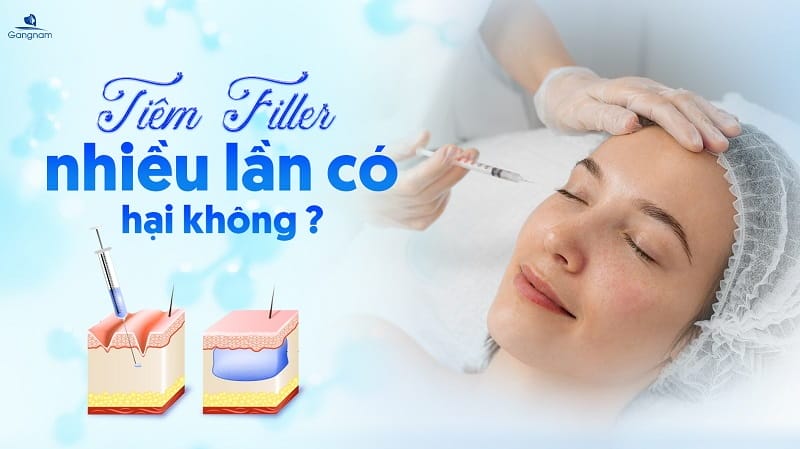So sánh nhanh các loại filler thường dùng