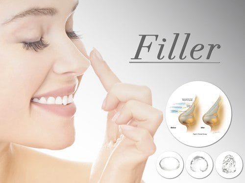 Thời gian duy trì filler được bao lâu?