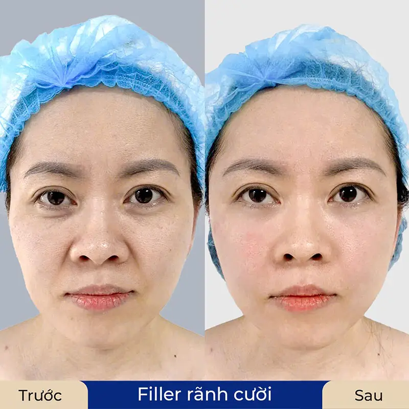 Quy trình tiêm rãnh cười an toàn — diễn ra như thế nào?
