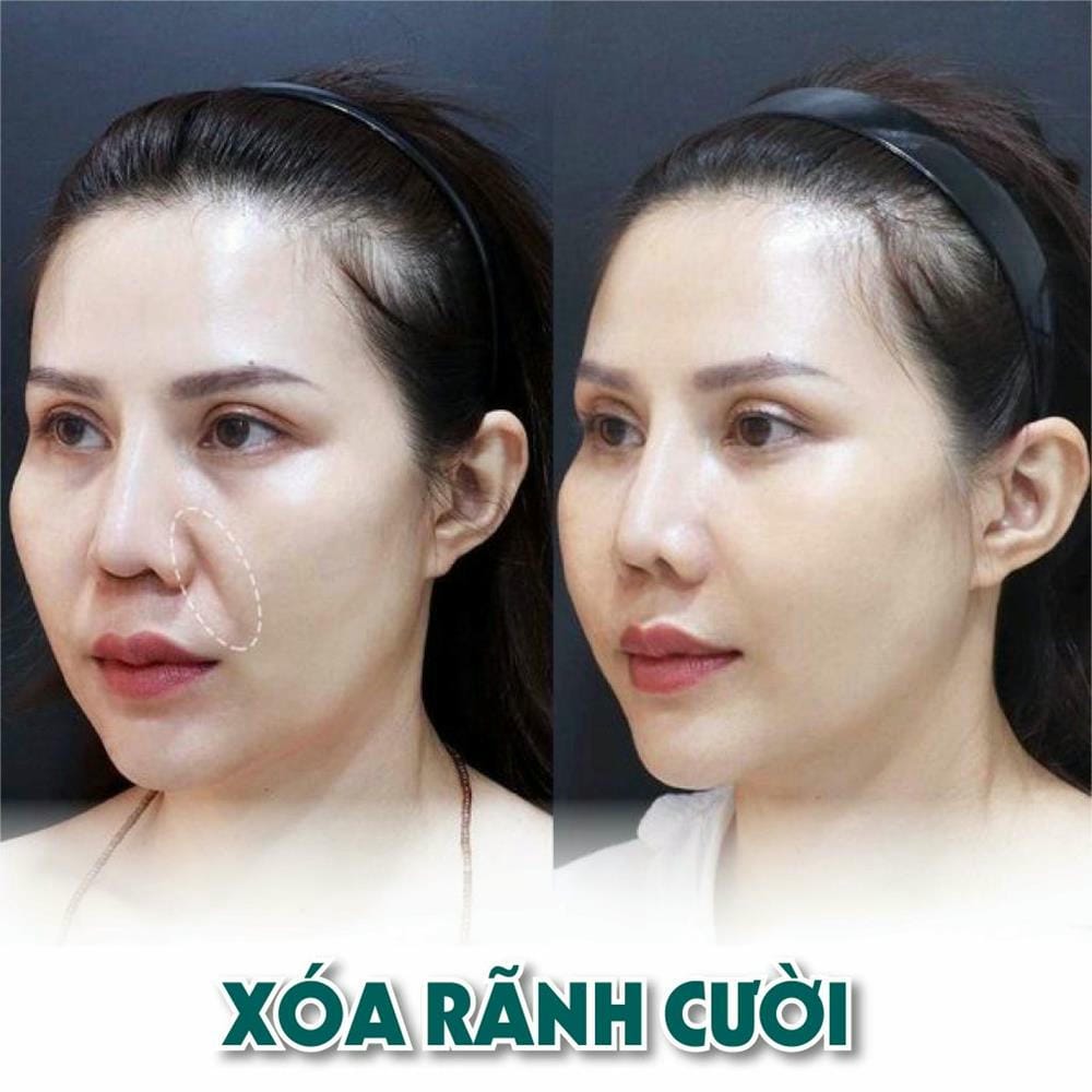 Tiêm filler rãnh cười giá bao nhiêu?