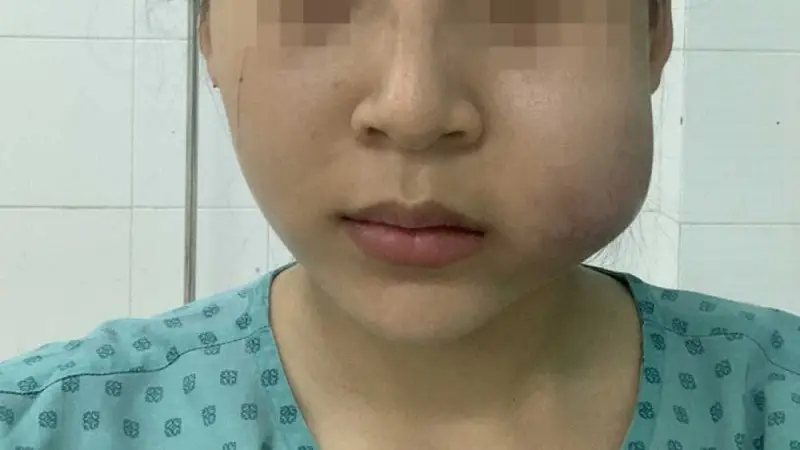 Khi nào cần xử trí ngay và những lựa chọn điều trị an toàn là gì? (Hyaluronidase, Siêu âm mô mềm)