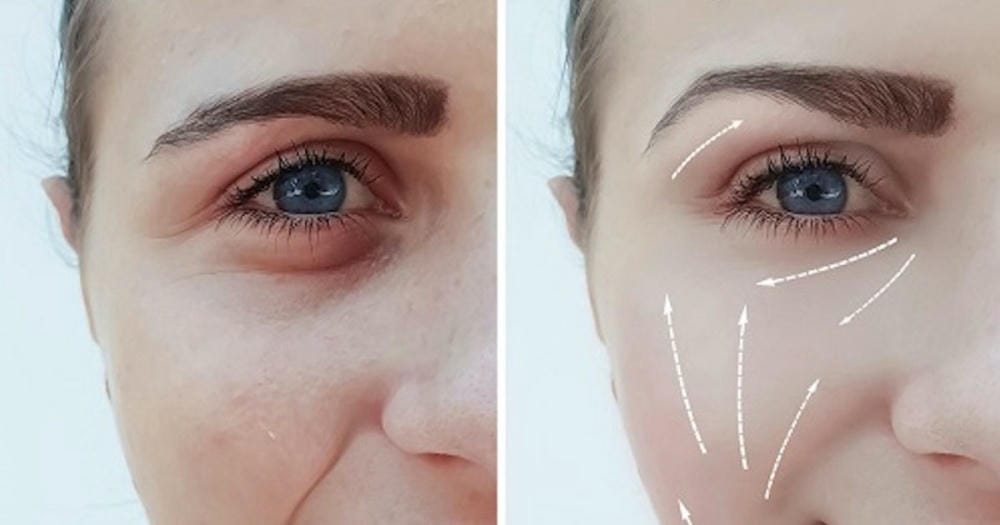 Tôi lo bị phù hoặc sẹo cục sau khi tiêm — làm sao để giảm rủi ro?