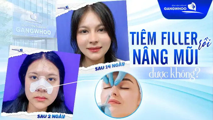 Nâng mũi bằng phẫu thuật và bằng filler: nên chọn khi nào?