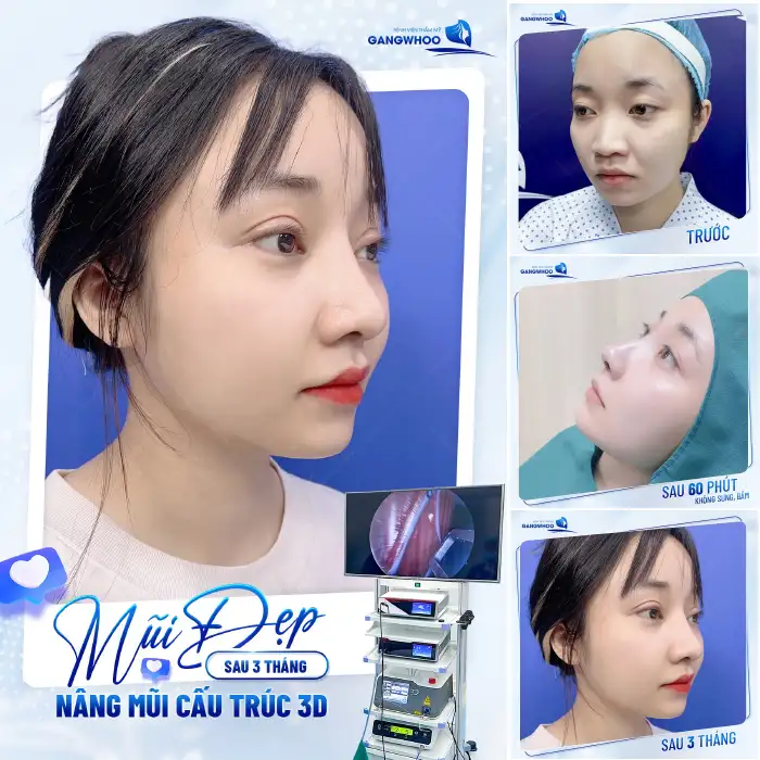 Nếu vẫn muốn tiêm filler: nên chọn loại nào để dễ xử trí nếu cần nâng mũi sau này?