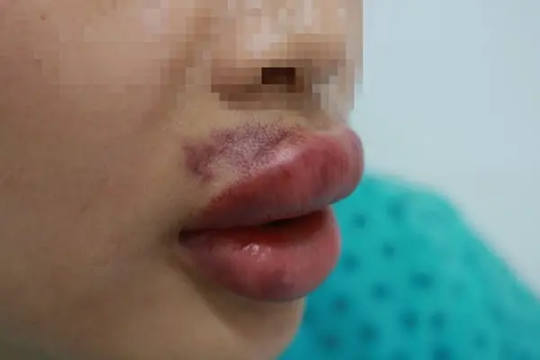 Nếu nghi ngờ tắc mạch — dấu hiệu tắc mạch filler và cần làm gì ngay?