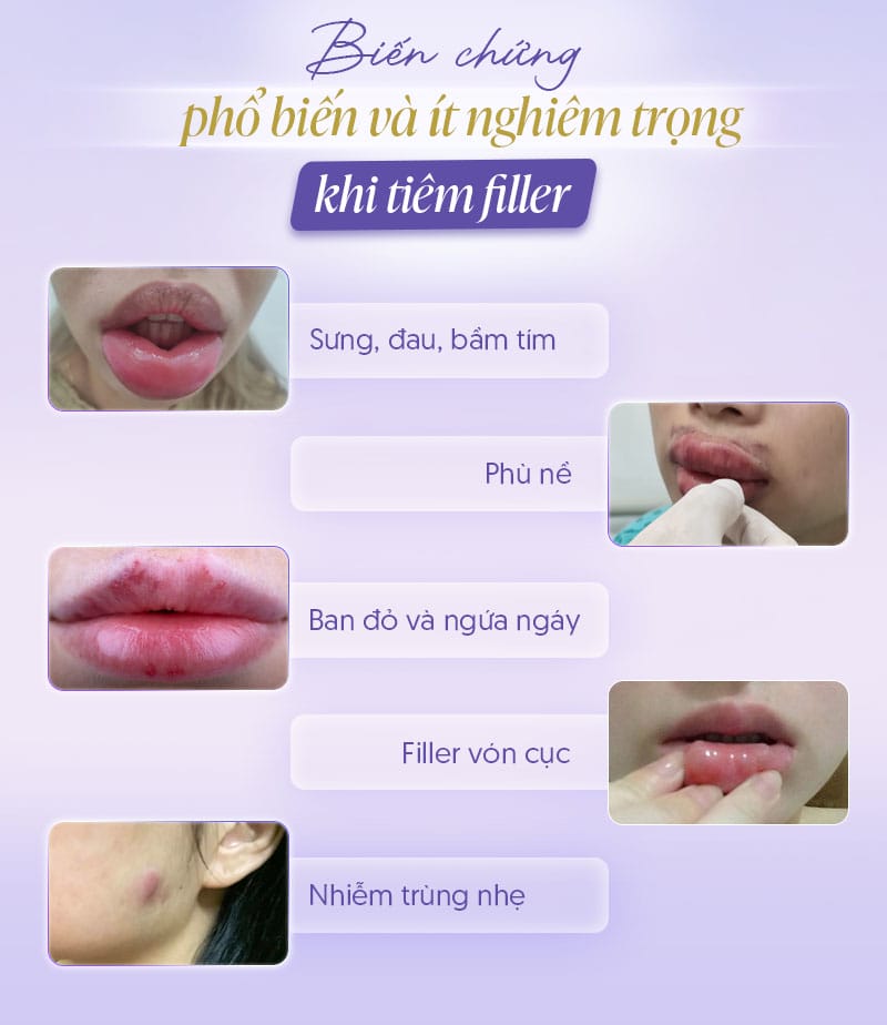 Biến chứng có thể xuất hiện sau khi tiêm đã nhiều năm không?
