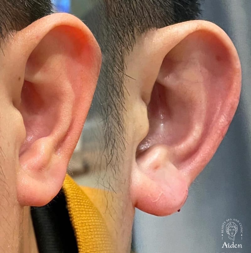 Tiêm filler tai có an toàn và có thay đổi rõ rệt không?