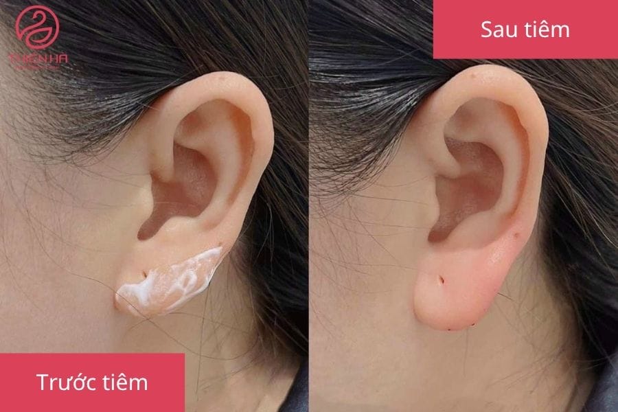 Chăm sóc sau tiêm và những điều nên/không nên làm