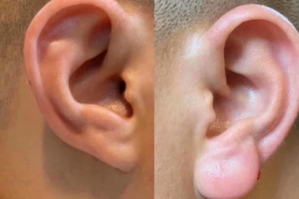 Tiêm filler tai Phật có nguy hiểm không — biến chứng hay gặp?