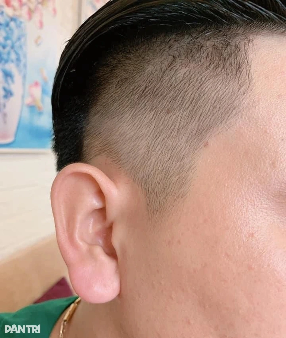 So sánh tiêm filler và phẫu thuật làm đầy dái tai