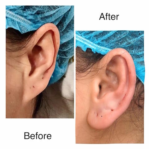 Tiêm filler tai tài lộc là gì và phù hợp với ai?