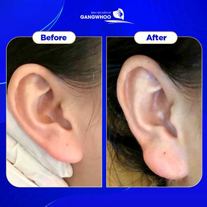 Làm sao để chọn nơi tiêm filler tai tài lộc an toàn và đạt kết quả tự nhiên?