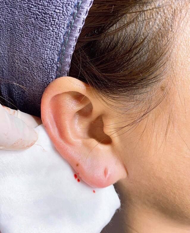 Ai không nên tiêm filler cho dái tai? Những chống chỉ định thường gặp?