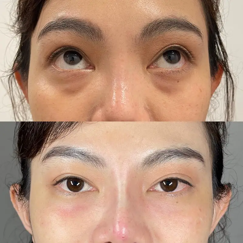 Cơ chế tác động của hyaluronic acid ở vùng tear trough