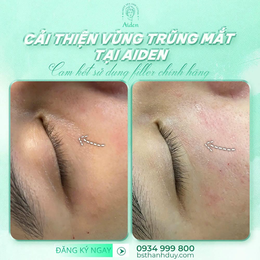 Nguy cơ và biến chứng khi tiêm filler vùng quầng thâm mắt — khi nào cần can thiệp khẩn?