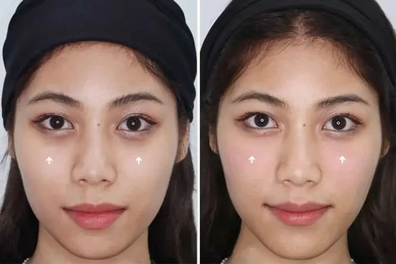 Có phương pháp thay thế hoặc nên kết hợp gì để hiệu quả lâu dài hơn?