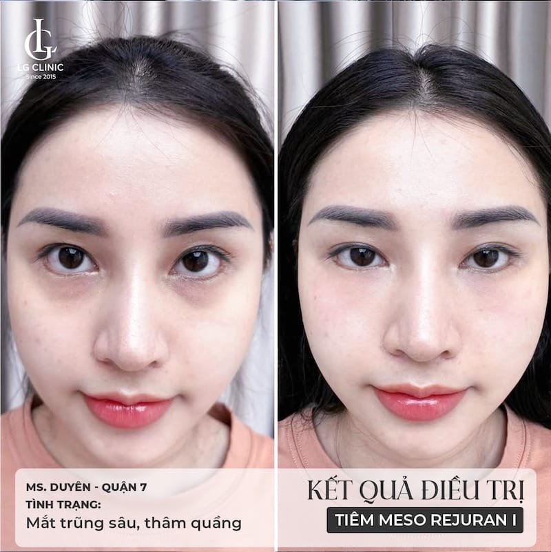 Tiêm filler tan quầng thâm mắt có thật sự xử lý quầng thâm?
