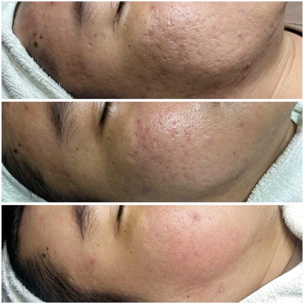 Tiêm filler tan sẹo là gì — cơ chế tác động ra sao?