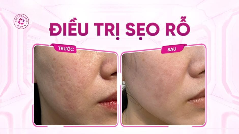 Bạn cần làm gì nếu quan tâm đến tiêm filler tan sẹo?