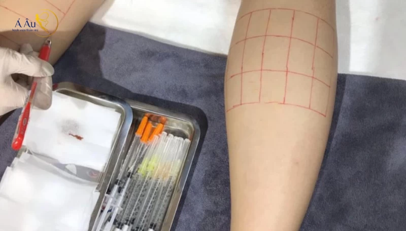 Bệnh cảnh biến chứng khi tiêm filler vào vùng chân có gì đáng lo nhất?