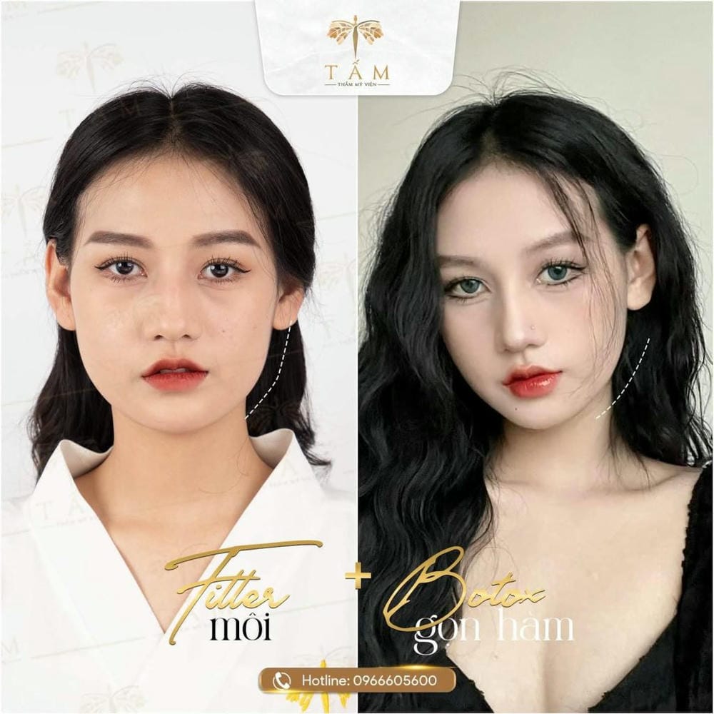 Tiêm filler thon gọn mặt có thực sự làm khuôn mặt nhỏ lại không?