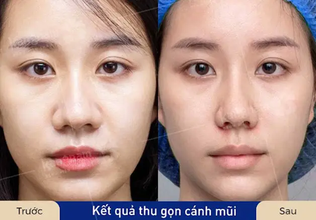 Quy trình tiêm filler thu gọn cánh mũi được thực hiện ra sao?