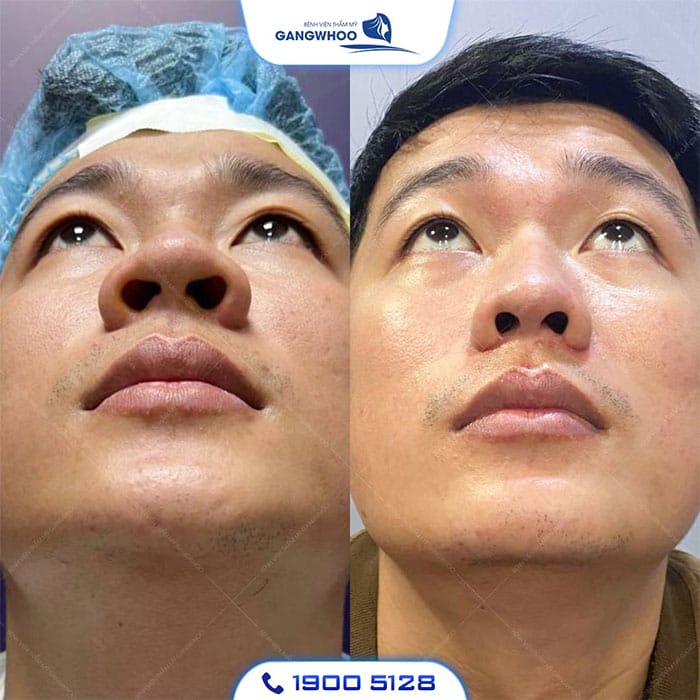 Loại filler HA nào phù hợp cho cánh mũi — Lona Skin Lab ưu tiên dòng nào?