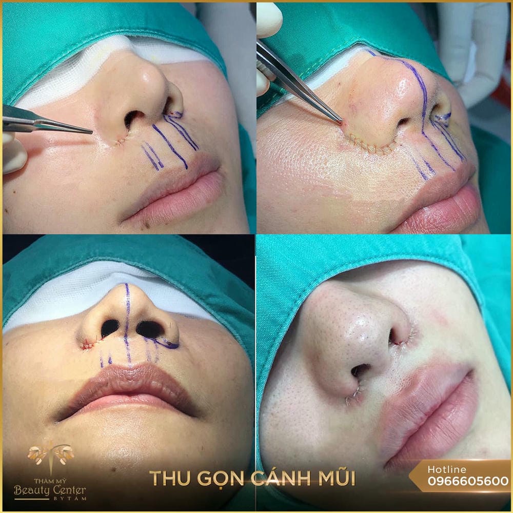 Ai phù hợp và ai không phù hợp để tiêm filler thu gọn cánh mũi?