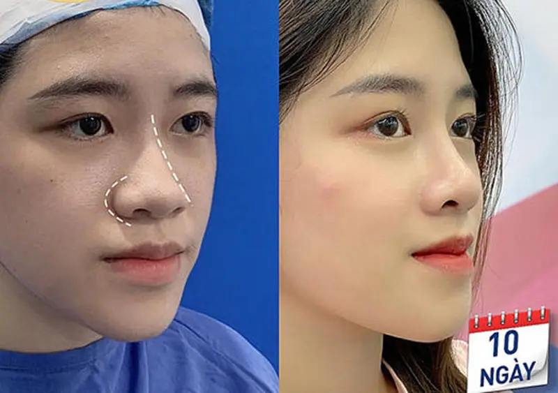 Bằng chứng lâm sàng cho nâng mũi không phẫu thuật và giới hạn hiện tại — có nên tin tưởng vào kết quả lâu dài?