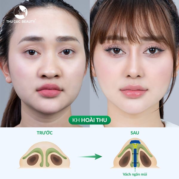 Quy trình tiêm filler an toàn cho đầu mũi — từng bước cần lưu ý