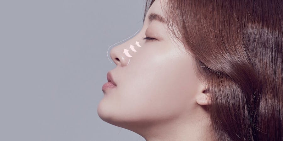 Nên dùng filler loại nào cho mũi — ưu tiên filler mũi HA